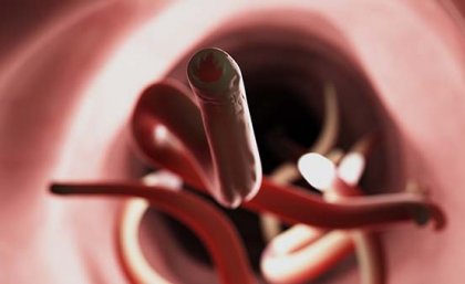 An artist's impression of hookworm inside a human intestine.